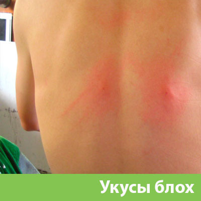 Укусы блох в Миассе