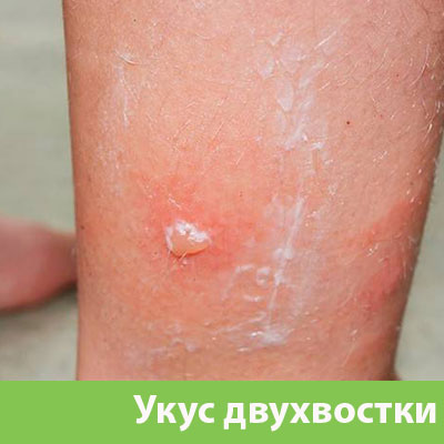 Укус двухвостки в Миассе