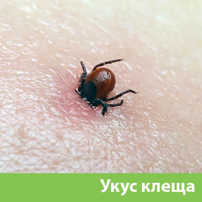 Укус клеща в Миассе