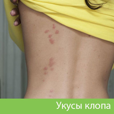Профессиональное уничтожение клопов в Миассе